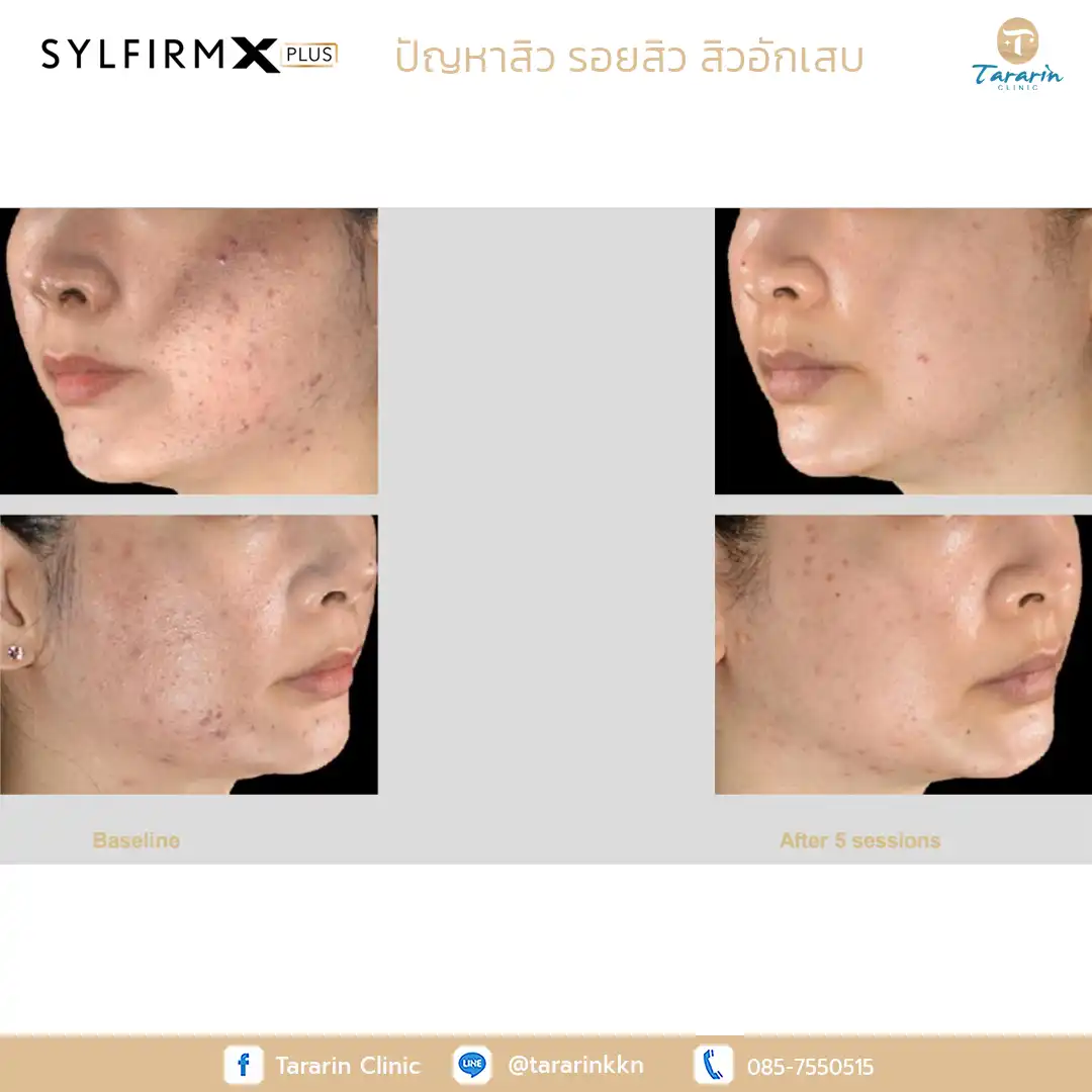 รีวิว Sylfirm x plus ผลลัพธ์ลดหลุมสิว