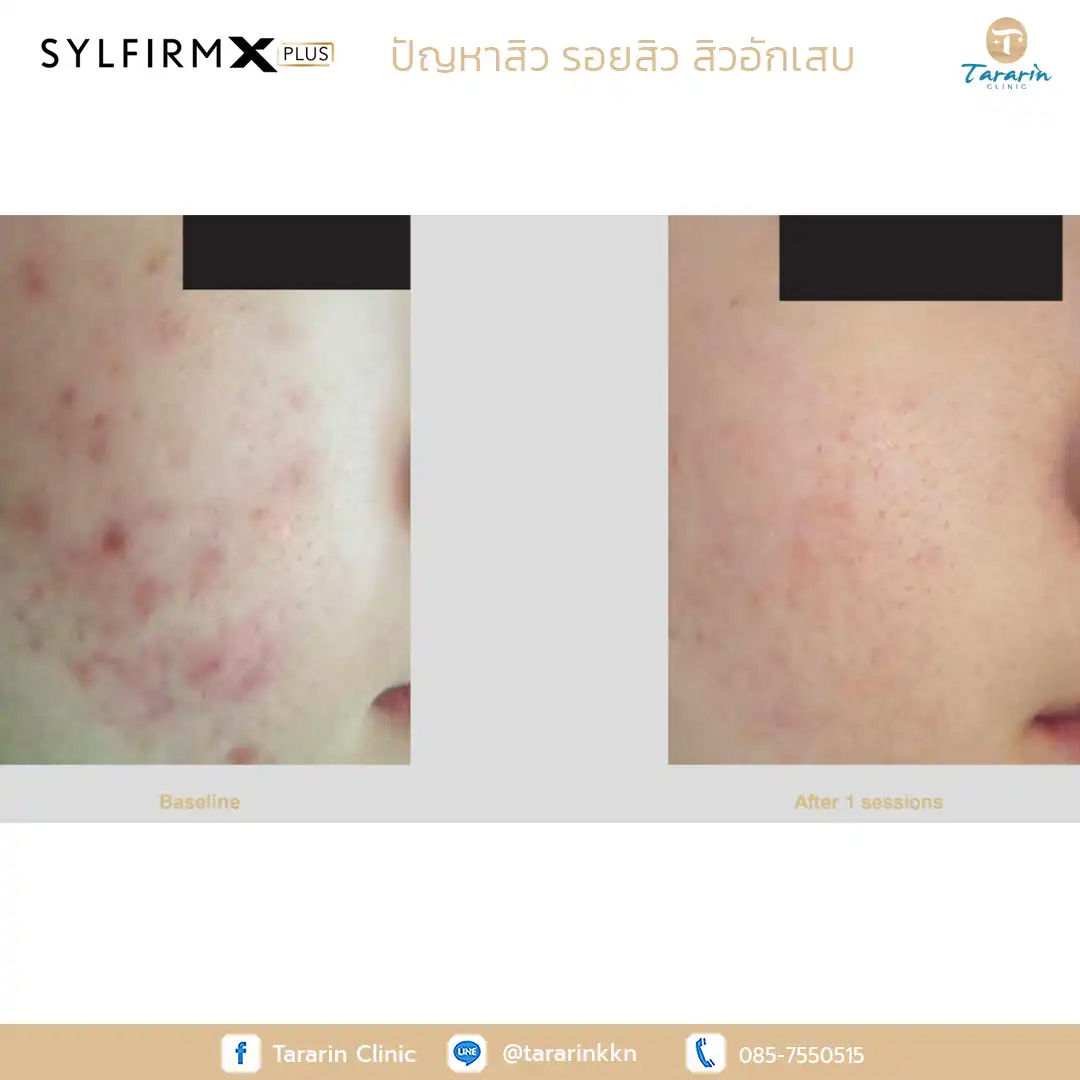 รีวิว Sylfirm x plus ผลลัพธ์ผิวเนียนใส