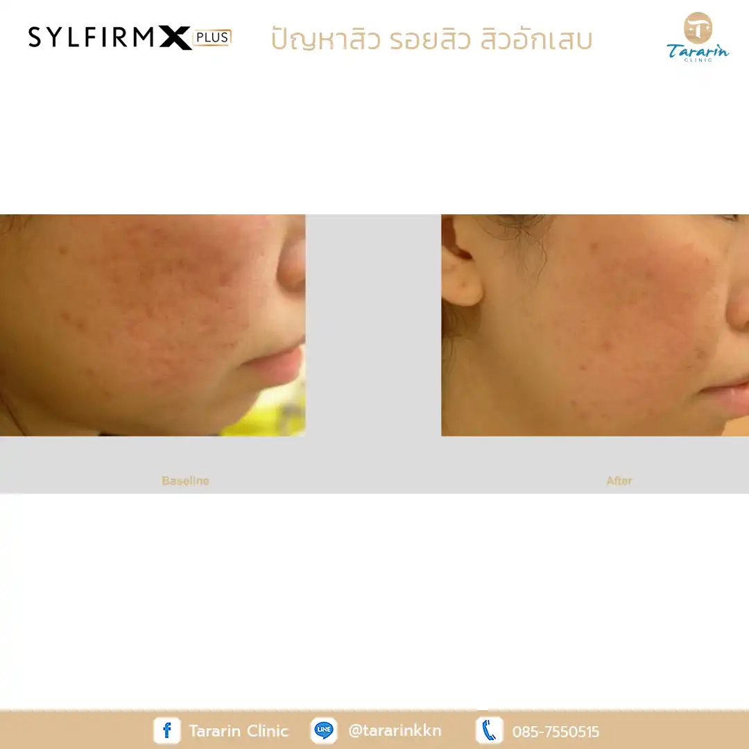 รีวิว Sylfirm x plus ผลลัพธ์กระชับรูขุมขน