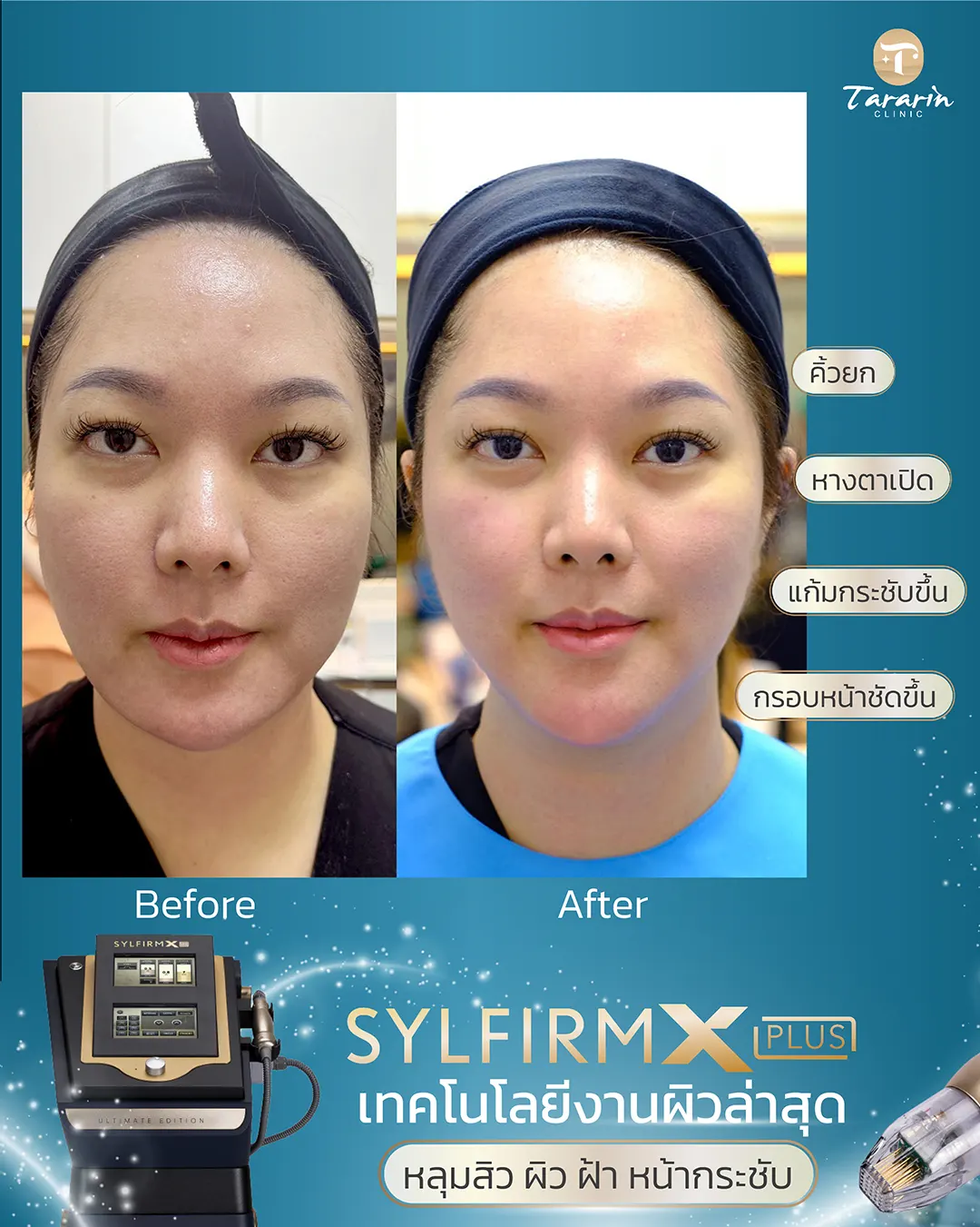 Sylfirm x plus รีวิวคุณสมบัติพิเศษ ก่อนทำ หลังทำ ธารารินคลินิก