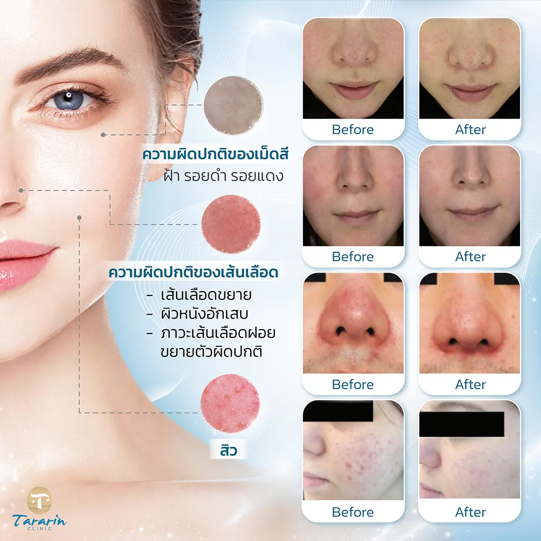 การรักษาด้วย Sylfirm x plus RF Microneedling ที่ธารารินคลินิก