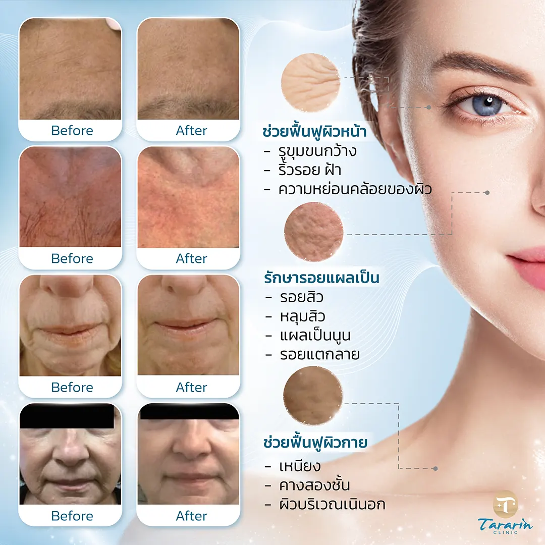 Sylfirm x plus รักษาผิวหน้าและผิวกาย ขอนแก่น