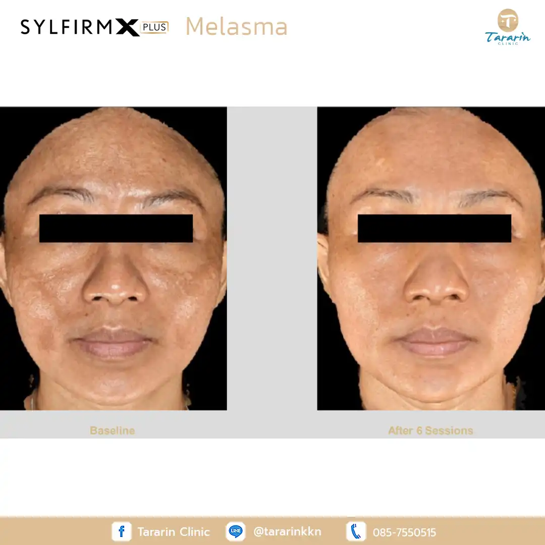 รีวิว Sylfirm x plus ผลลัพธ์รักษาหลุมสิว