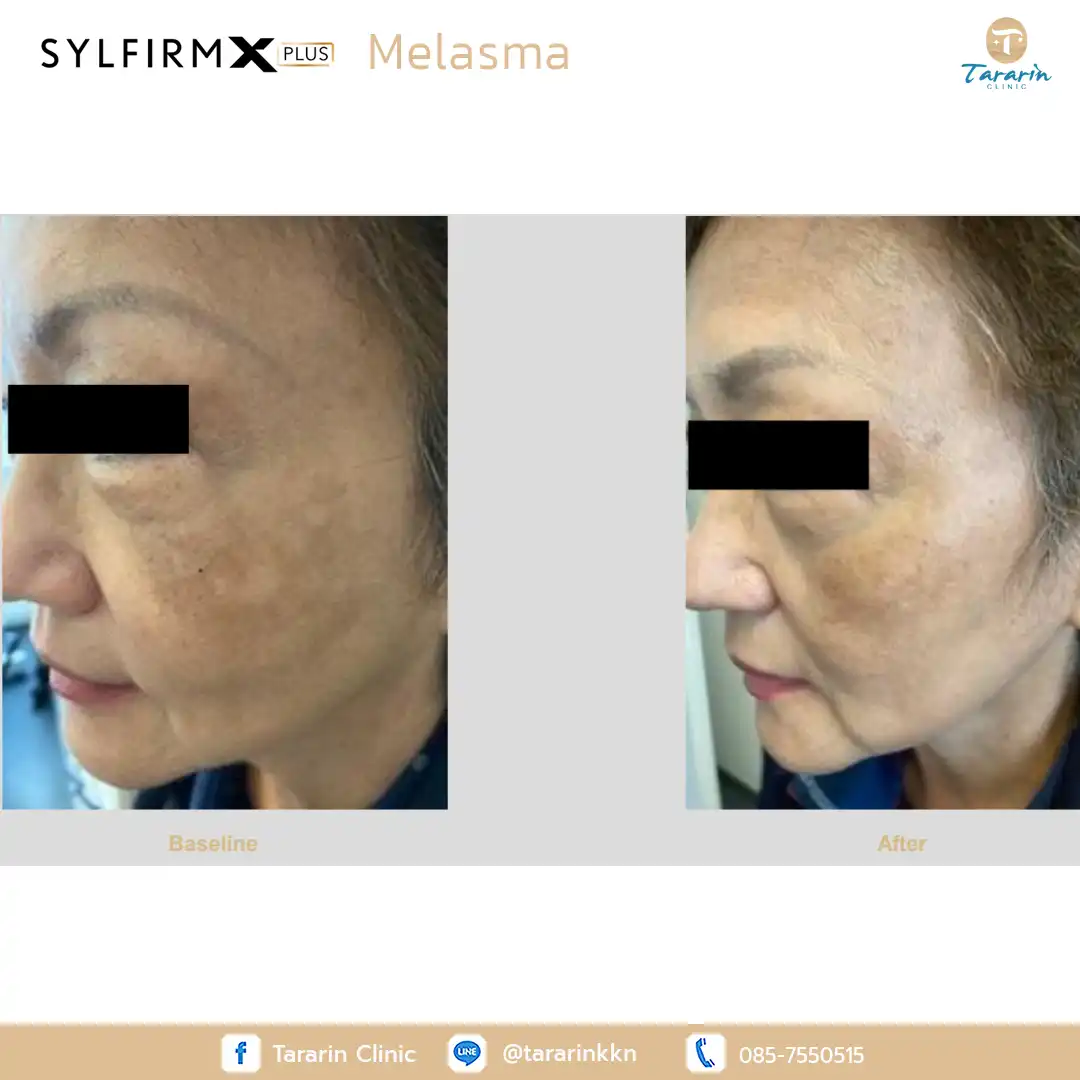 รีวิว Sylfirm x plus ผลลัพธ์รักษารูขุมขนกว้าง