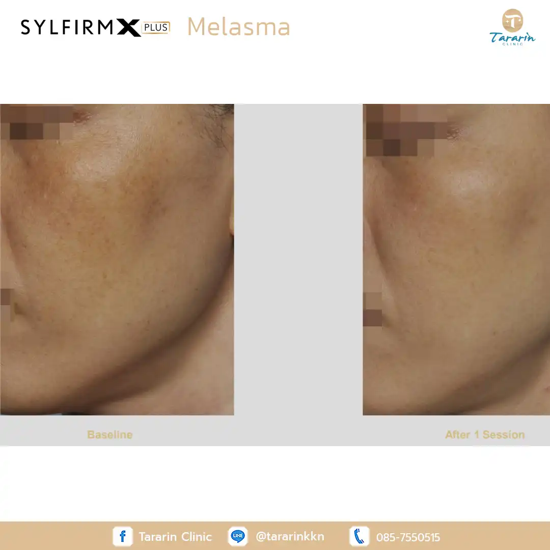 รีวิว Sylfirm x plus ผลลัพธ์รักษารอยสิว