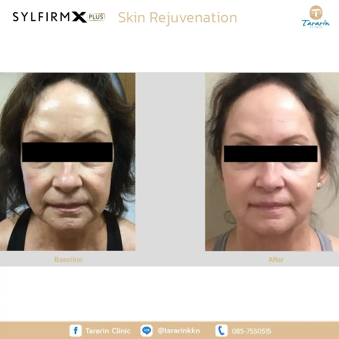 รีวิว Sylfirm x plus ผลลัพธ์รักษาฝ้า กระ