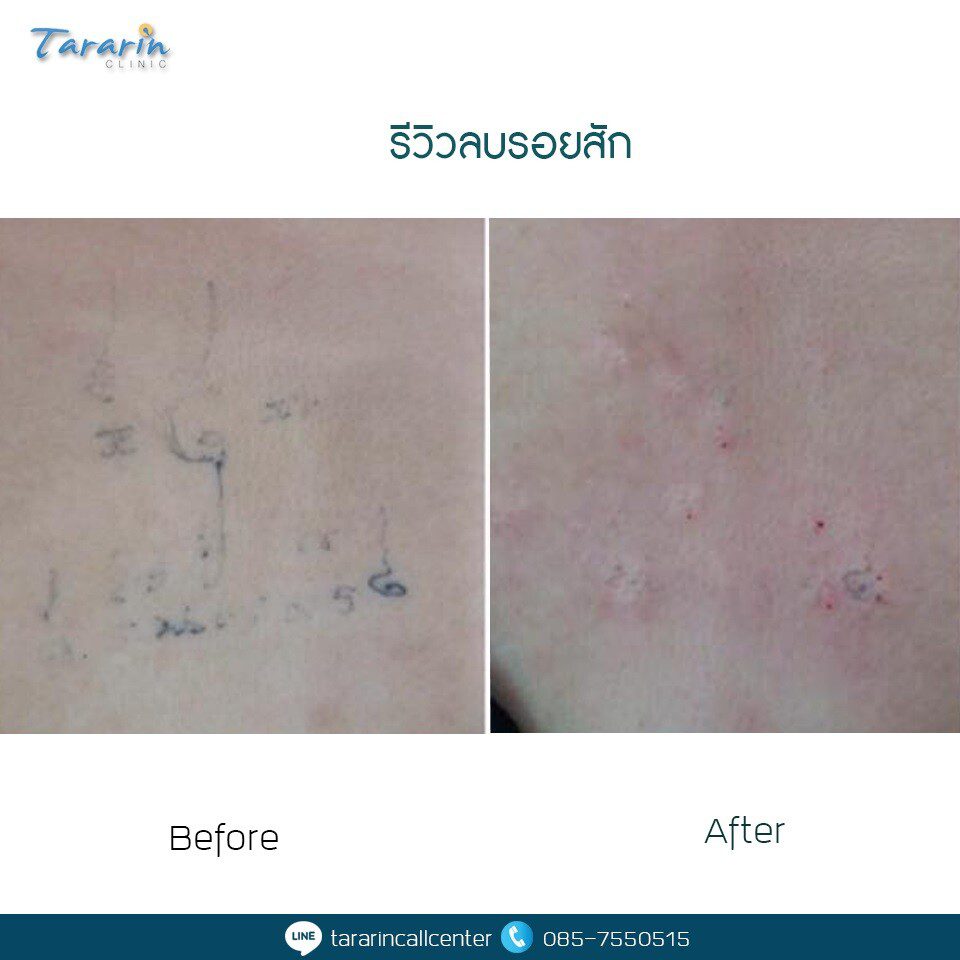 รีวิวลบรอยสักด้วยเลเซอร์ผลลัพธ์ก่อน-หลัง 2