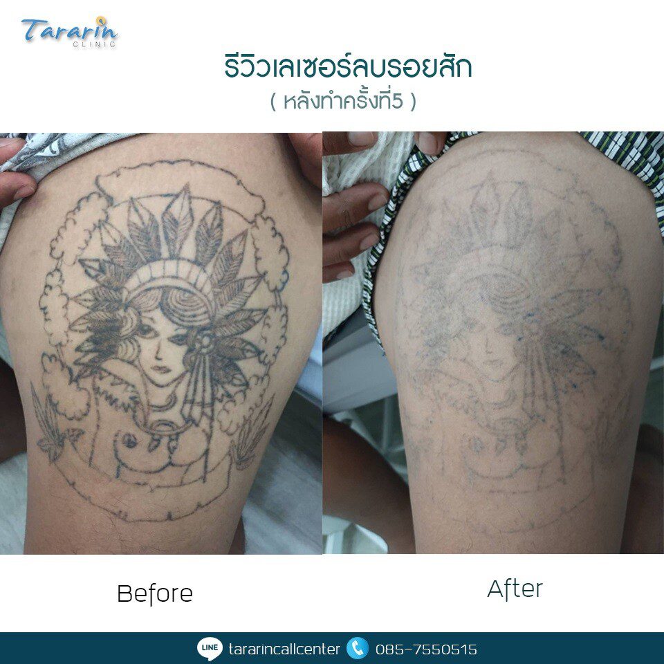 รีวิวลบรอยสักเลเซอร์ขอนแก่นผลลัพธ์จริง 3