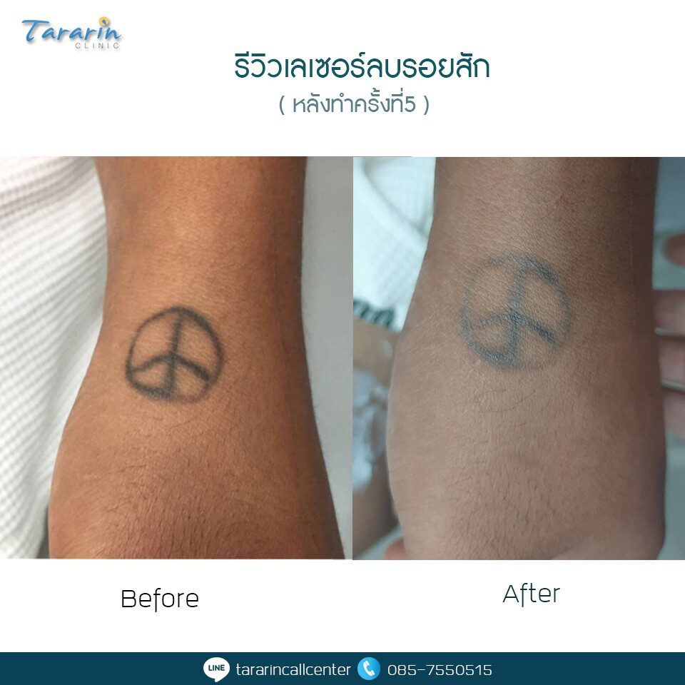 รีวิวเลเซอร์ลบรอยสักคิ้วผลลัพธ์ก่อนหลัง 4