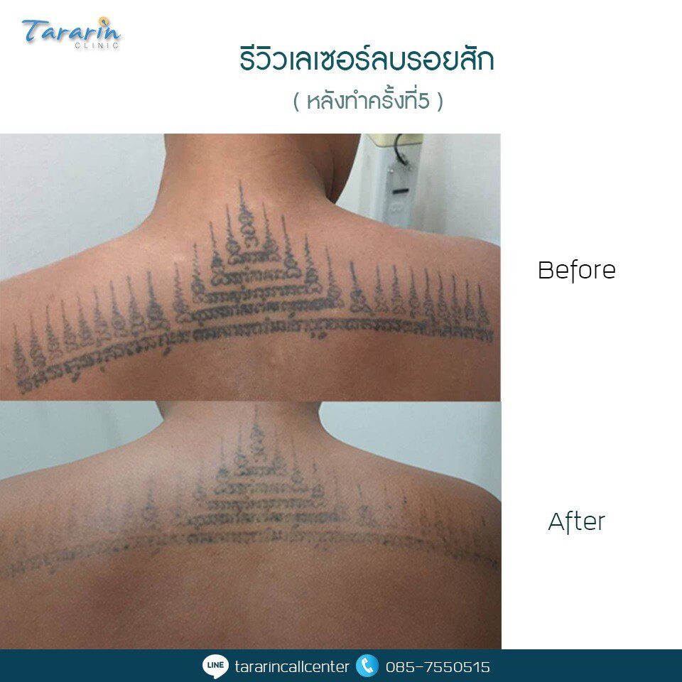 รีวิวลบรอยสักมหาสารคามร้อยเอ็ดผลจริง 5
