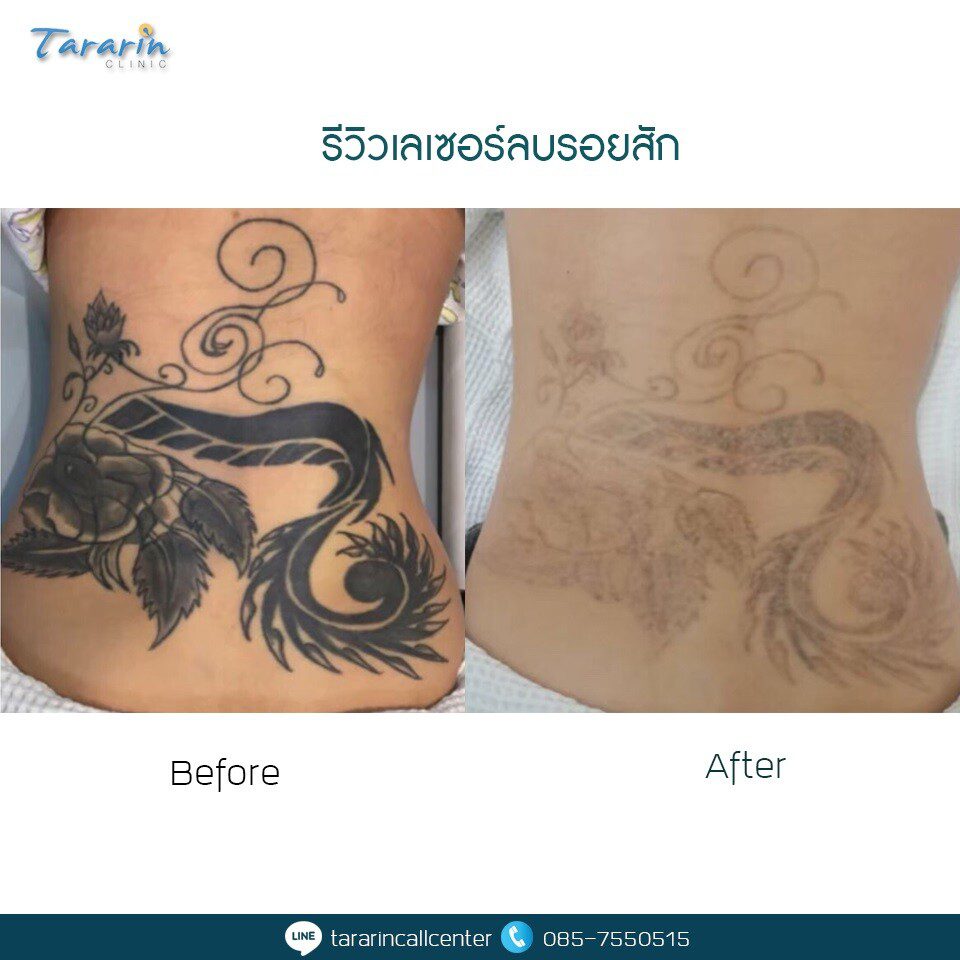 รีวิวลบรอยสักธาราริน คลินิกผลลัพธ์ล่าสุด 6