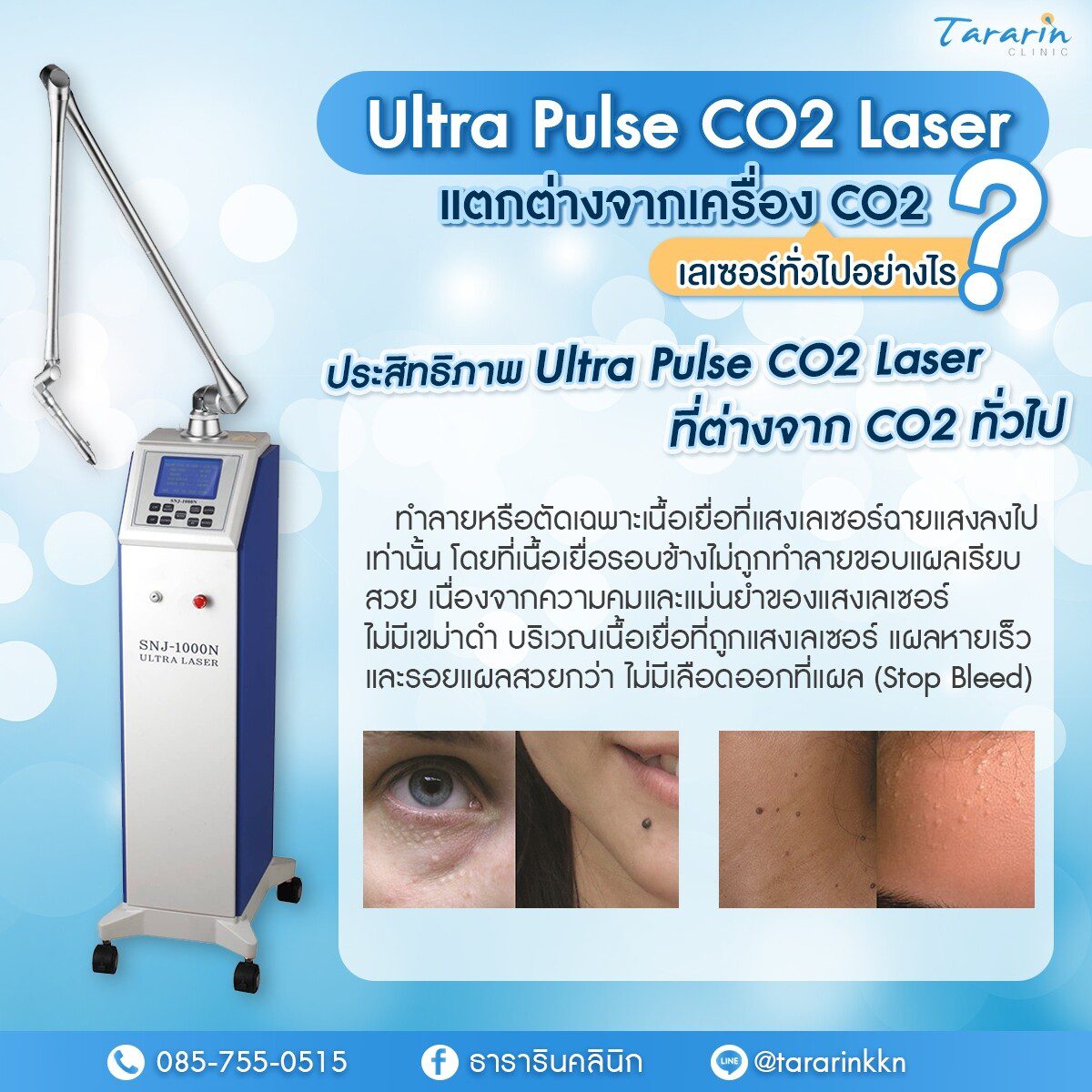 Ultra Pulse CO2 Laser กำจัดไฝ จี้ไฝ