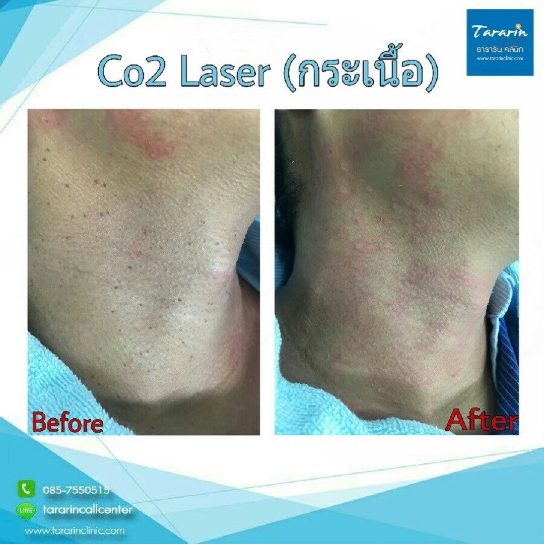 รีวิวผลลัพธ์การกำจัดไฝ Ultrapulse CO2 Laser