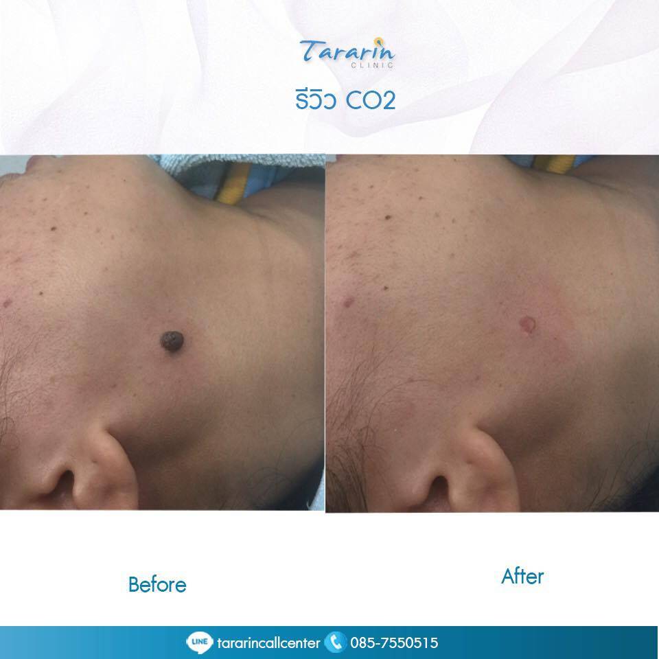 รีวิวผลลัพธ์การกำจัดขี้แมลงวัน Ultrapulse CO2 Laser