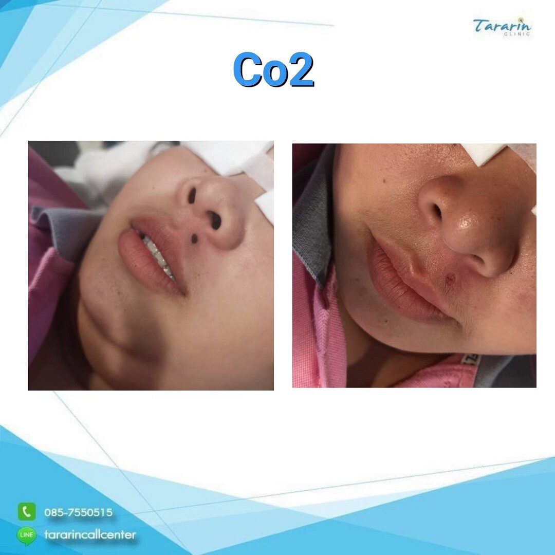 รีวิวการรักษาสิวหิน Ultrapulse CO2 Laser