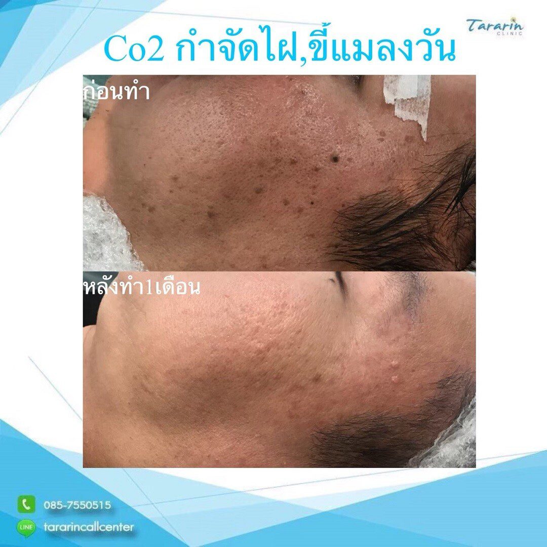 รีวิวการรักษาสิวอุดตัน Ultrapulse CO2 Laser
