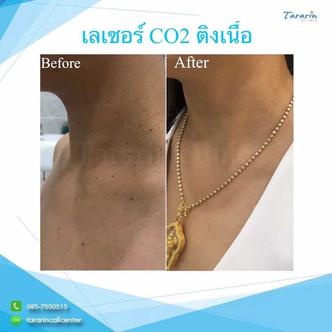 รีวิวกระเนื้อ Ultrapulse CO2 Laser ขอนแก่น
