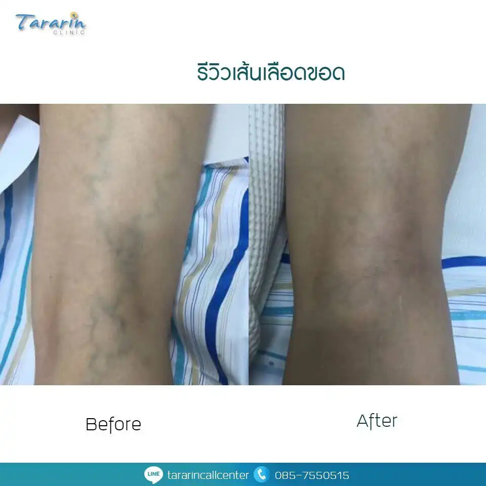 ผลการรักษาเส้นเลือดขอดที่ธารารินคลินิก before after review