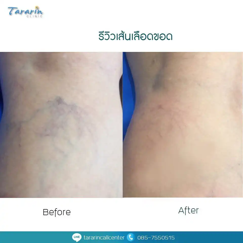 ผลการรักษาเส้นเลือดขอดด้วย ND YAG laser before after