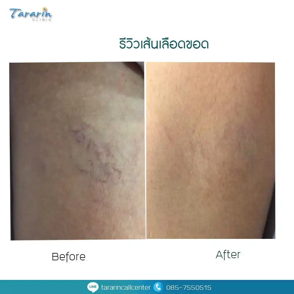 ผลลัพธ์รักษาเส้นเลือดขอดด้วยเลเซอร์ before after ขา