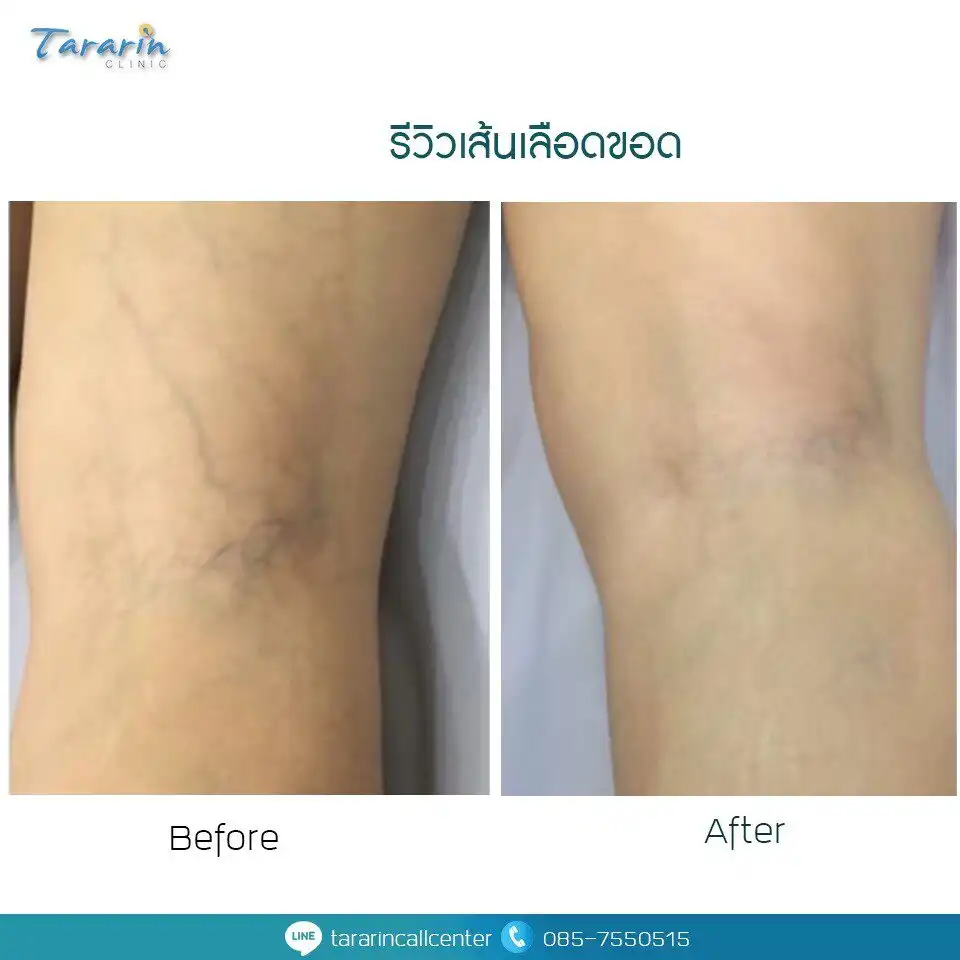 ผลการรักษาเส้นเลือดขอดขาเรียบเนียน before after