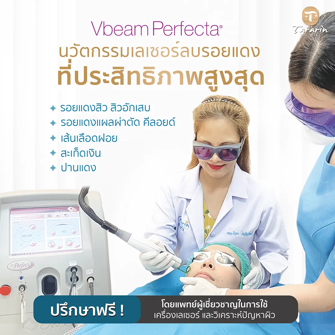 VBeam Perfecta เลเซอร์รักษารอยแดง