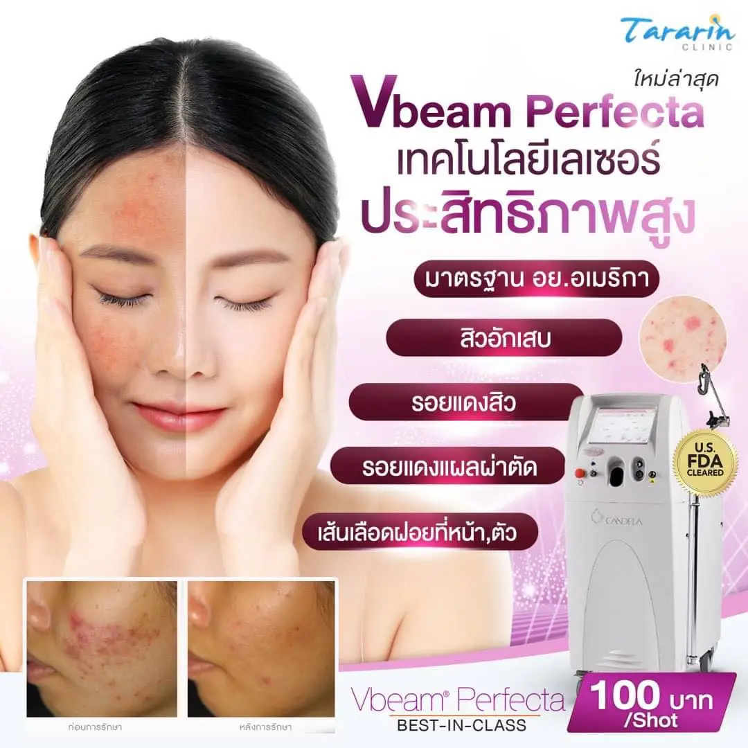 ทำไมควรเลือก VBeam Perfecta รักษารอยแดง