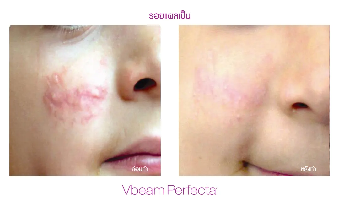 ผลลัพธ์ Vbeam รักษาริ้วรอยและหน้าท้องลาย
