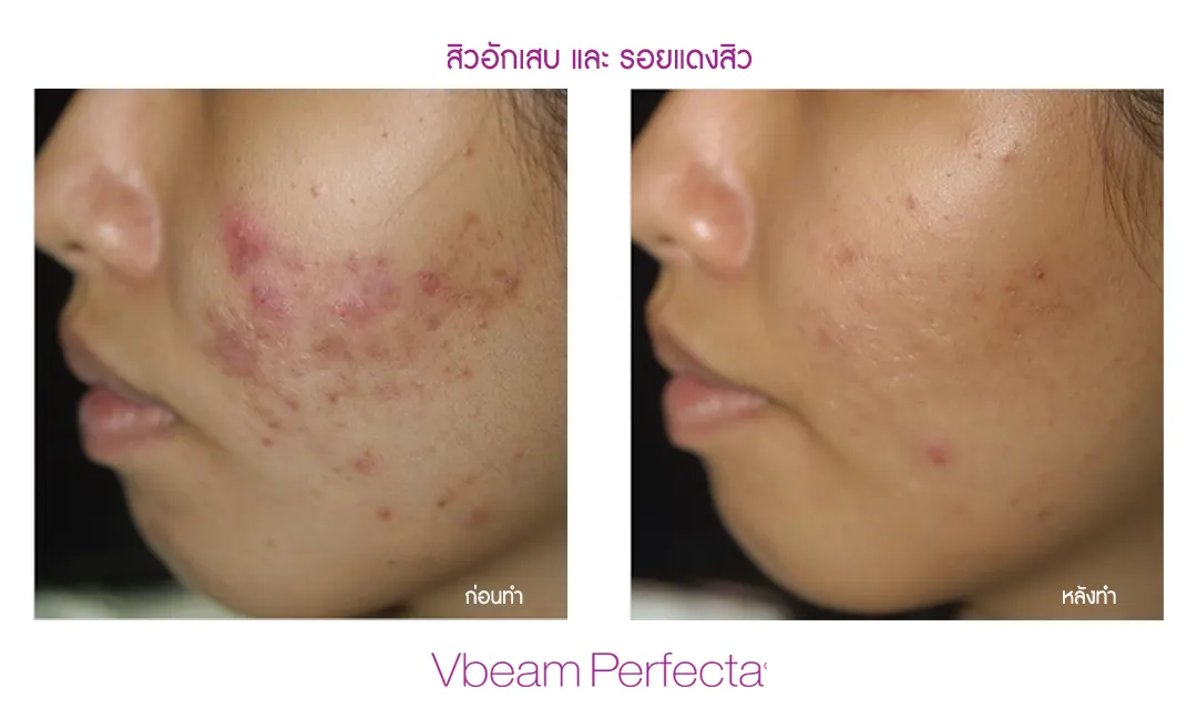 ผลลัพธ์การรักษาด้วย Vbeam Laser ก่อนและหลัง