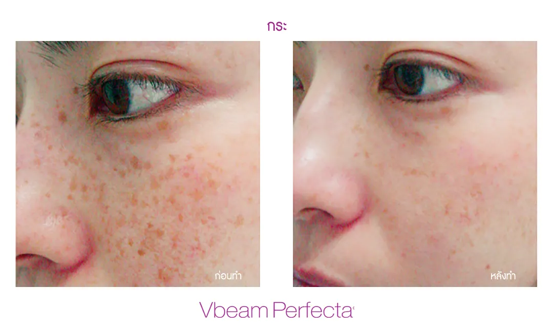 ผลลัพธ์ Vbeam รักษาเส้นเลือดฝอยขยาย