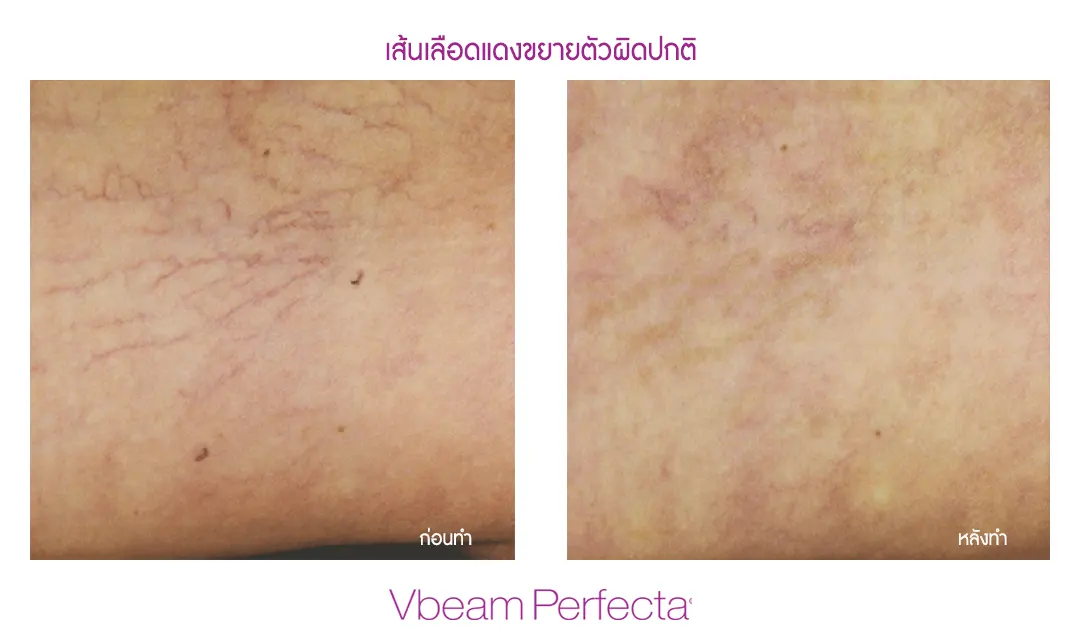 ผลลัพธ์ Vbeam รักษาปานแดง