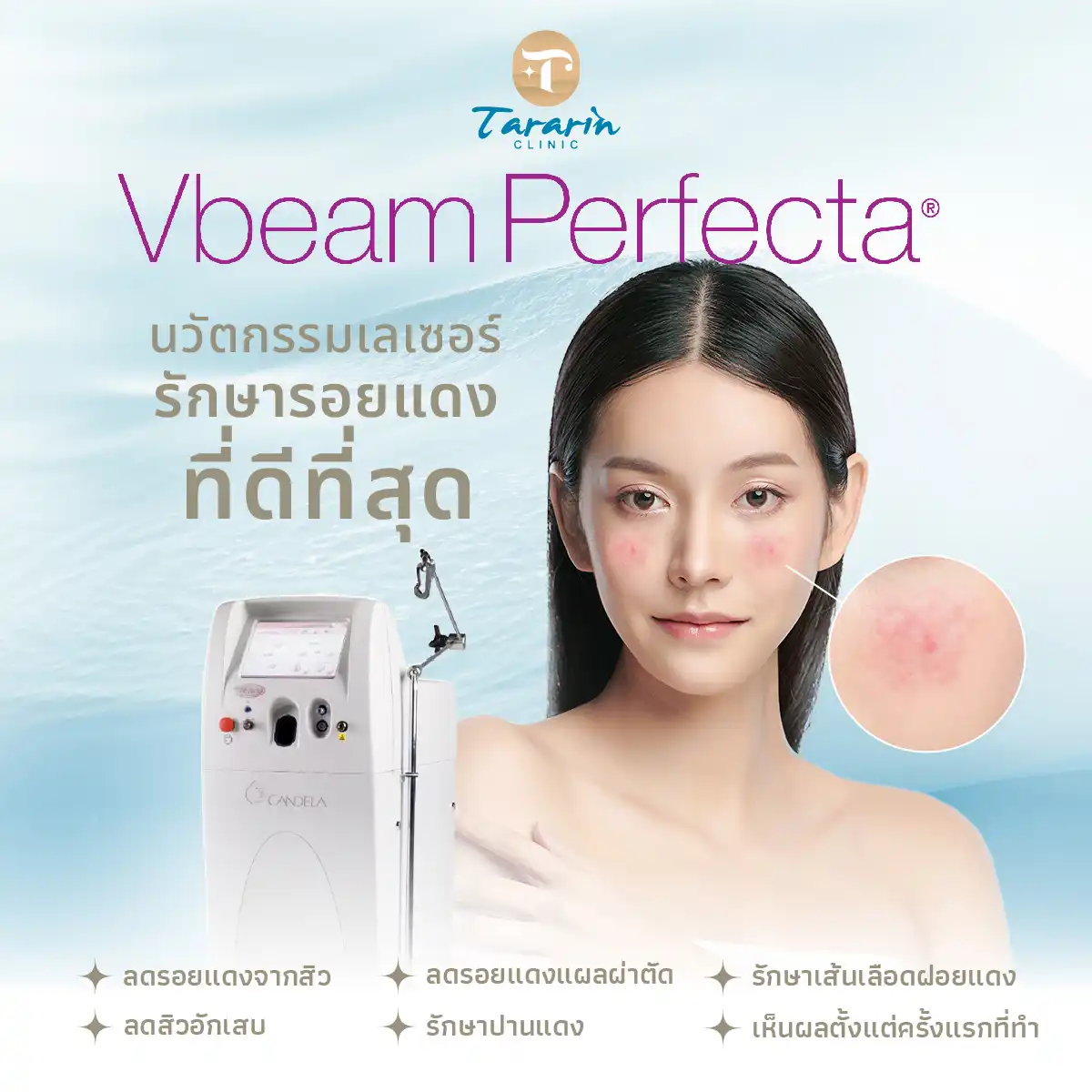 รู้จัก Vbeam Laser รุ่น Perfecta ท็อปใหม่ล่าสุด เทคโนโลยีที่รักษารอยโรคผิวหนังได้มากกว่า 20 ชนิด