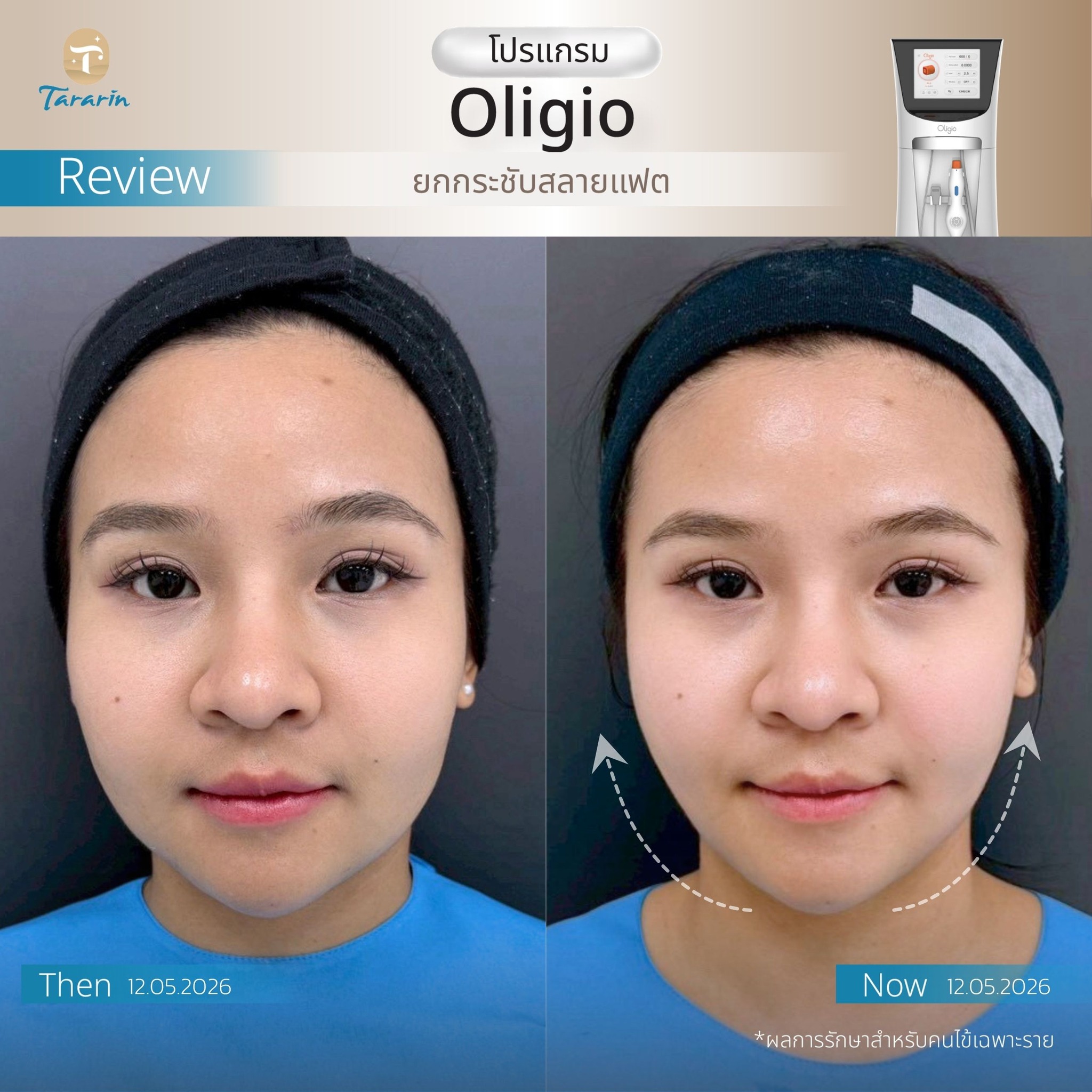 รีวิวยกกระชับผิว Oligio เก็บกรอบหน้า แก้ย้อย