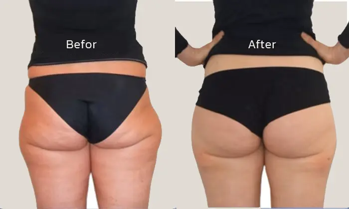 ผลลัพธ์ Aqualyx สลายไขมันเฉพาะจุด