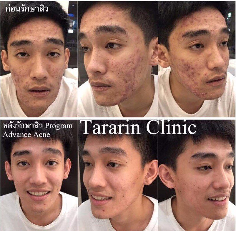 รักษาสิว ADVANCE ACNE