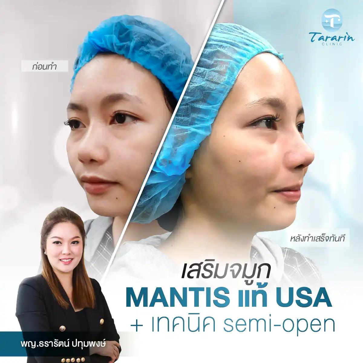 เสริมจมูก ซิลิโคนตั๊กแตน USA Mantis