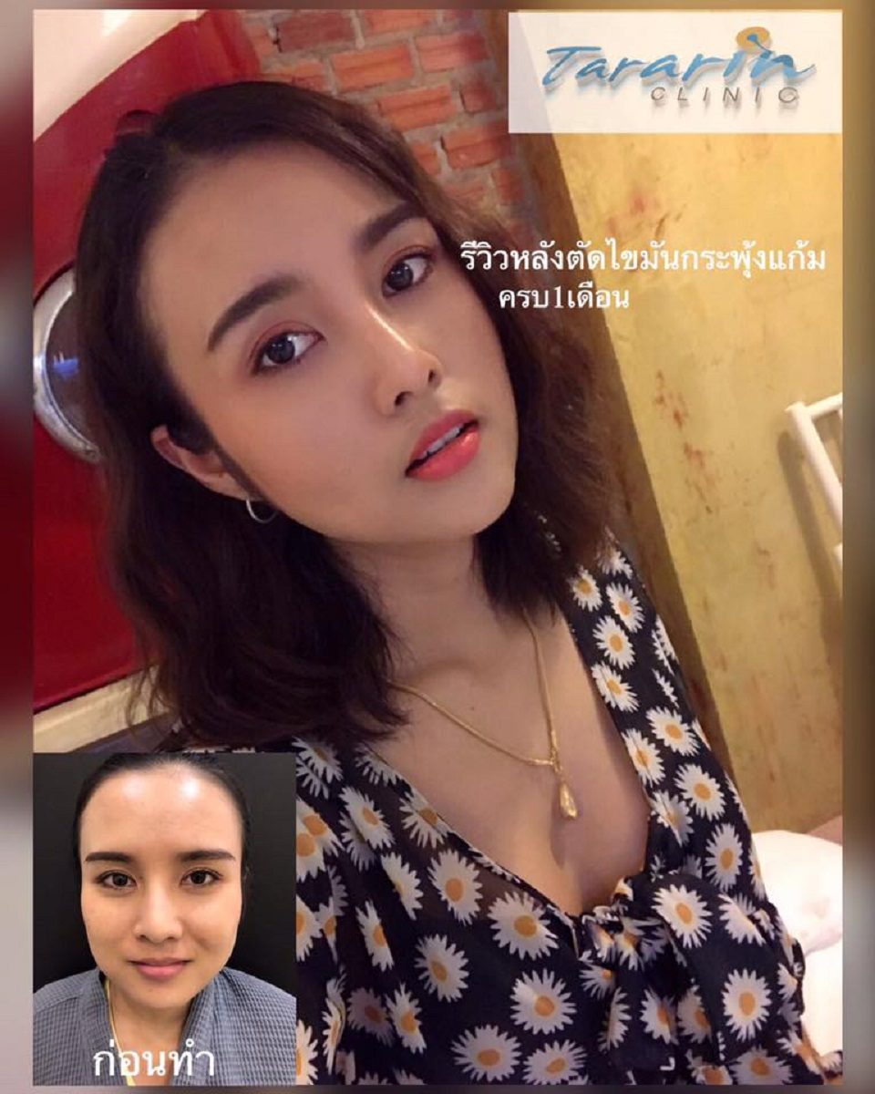 ผ่าตัดไขมันกระพุ้งแก้ม ช่วยหน้าเรียว V Shap