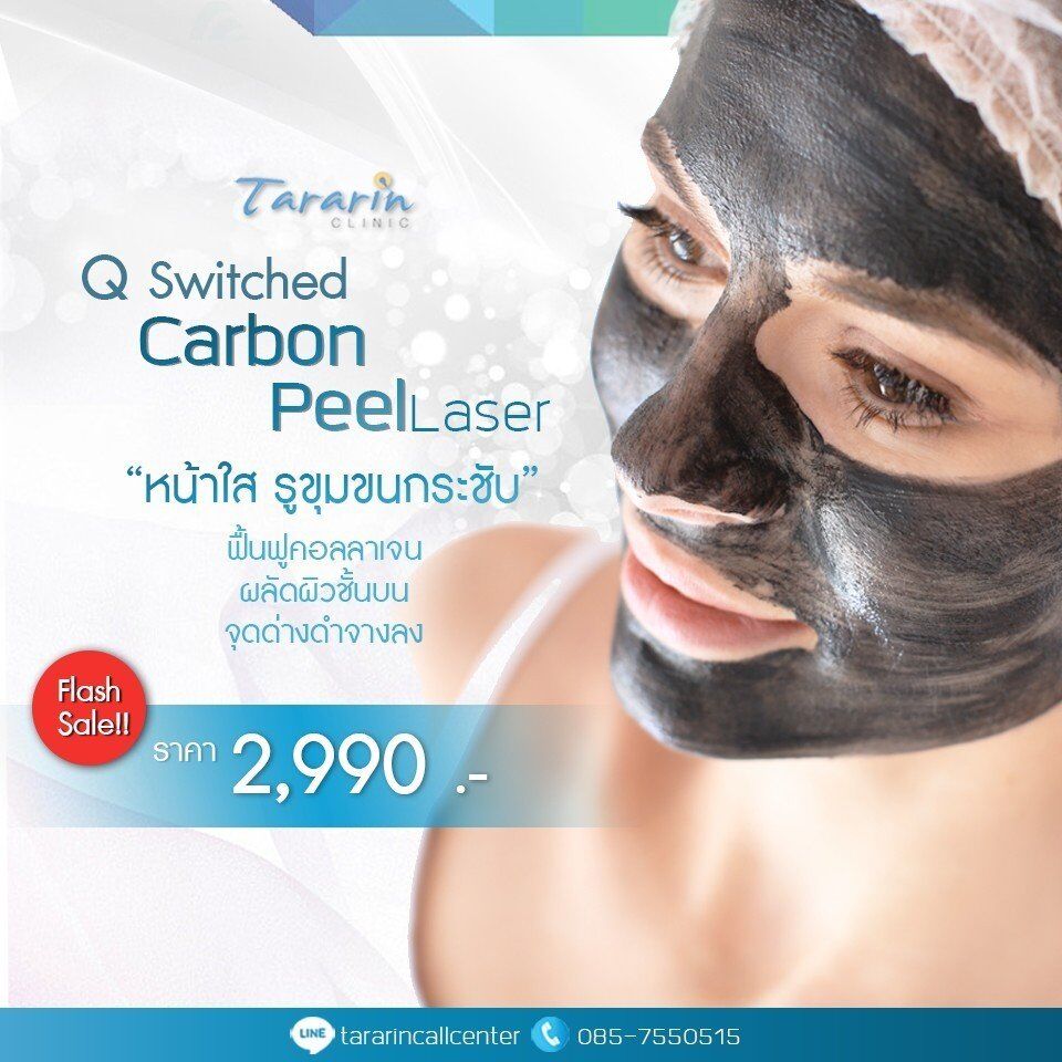 Carbon Peel เลเซอร์หน้าใส กระตุ้นคอลลาเจน กระชับรูขุมขน