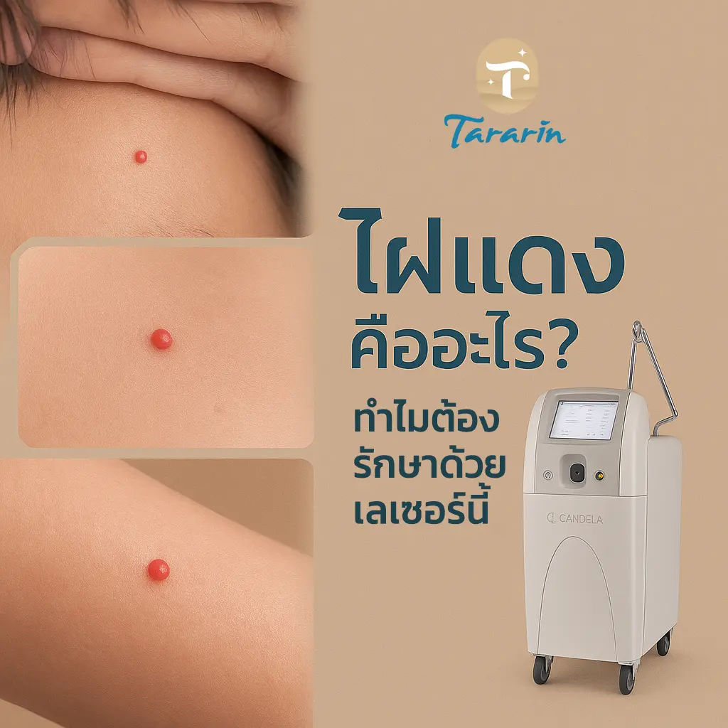 ”ไฝแดง” บนผิวรักษาได้ ด้วยเลเซอร์ Vbeam Perfecta