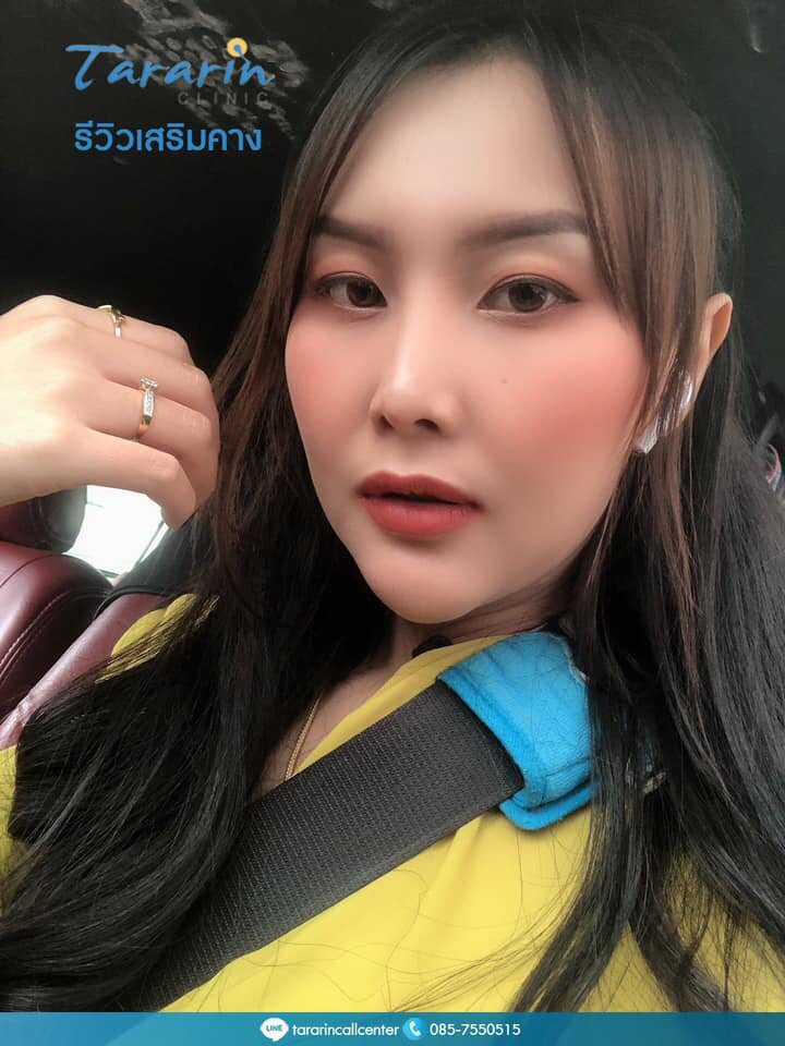 เสริมคาง ให้หน้าเรียวสวยเข้ารูป