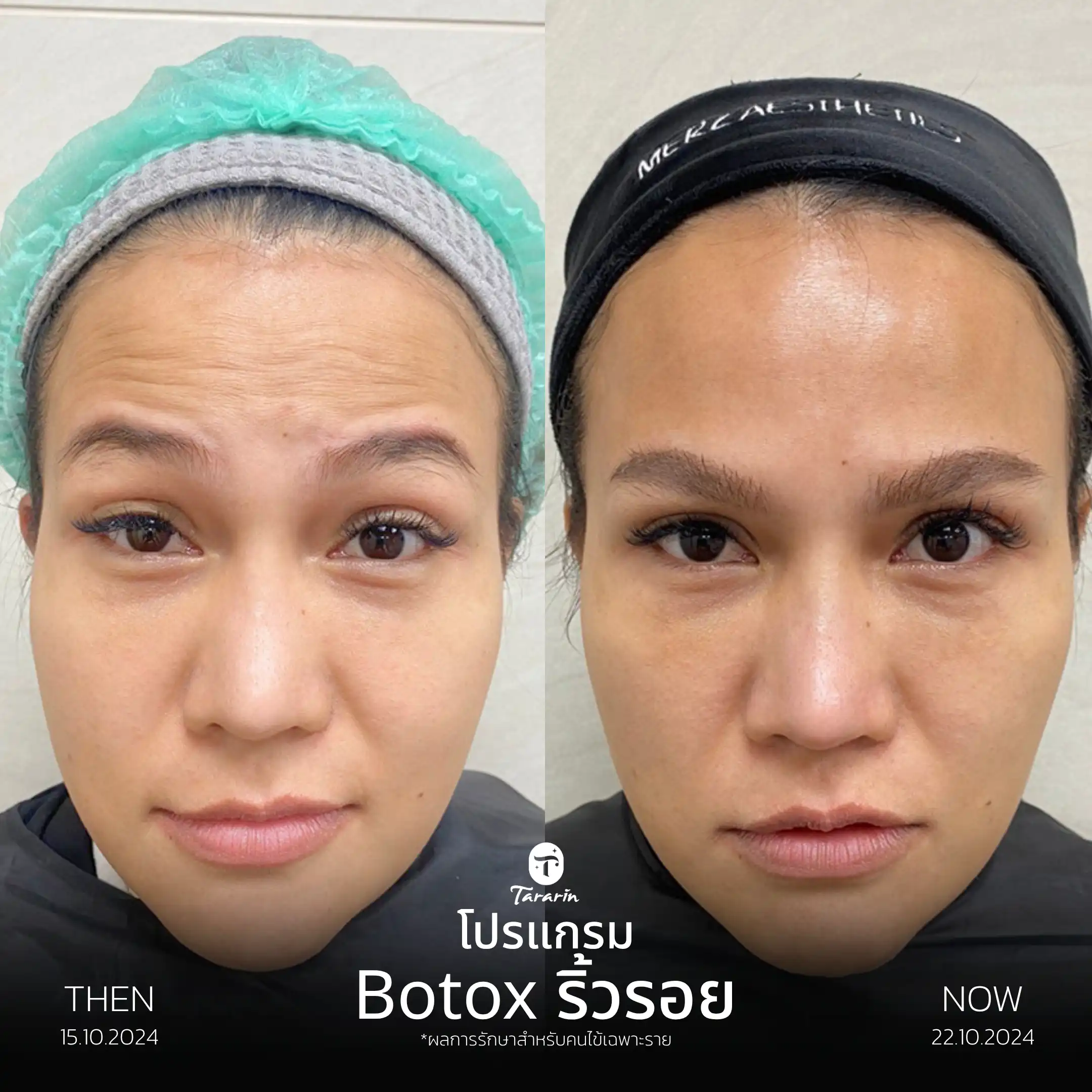 รีวิวโปรแกรมโบทูลินัม ลดริ้วรอย — ธารารินคลินิก