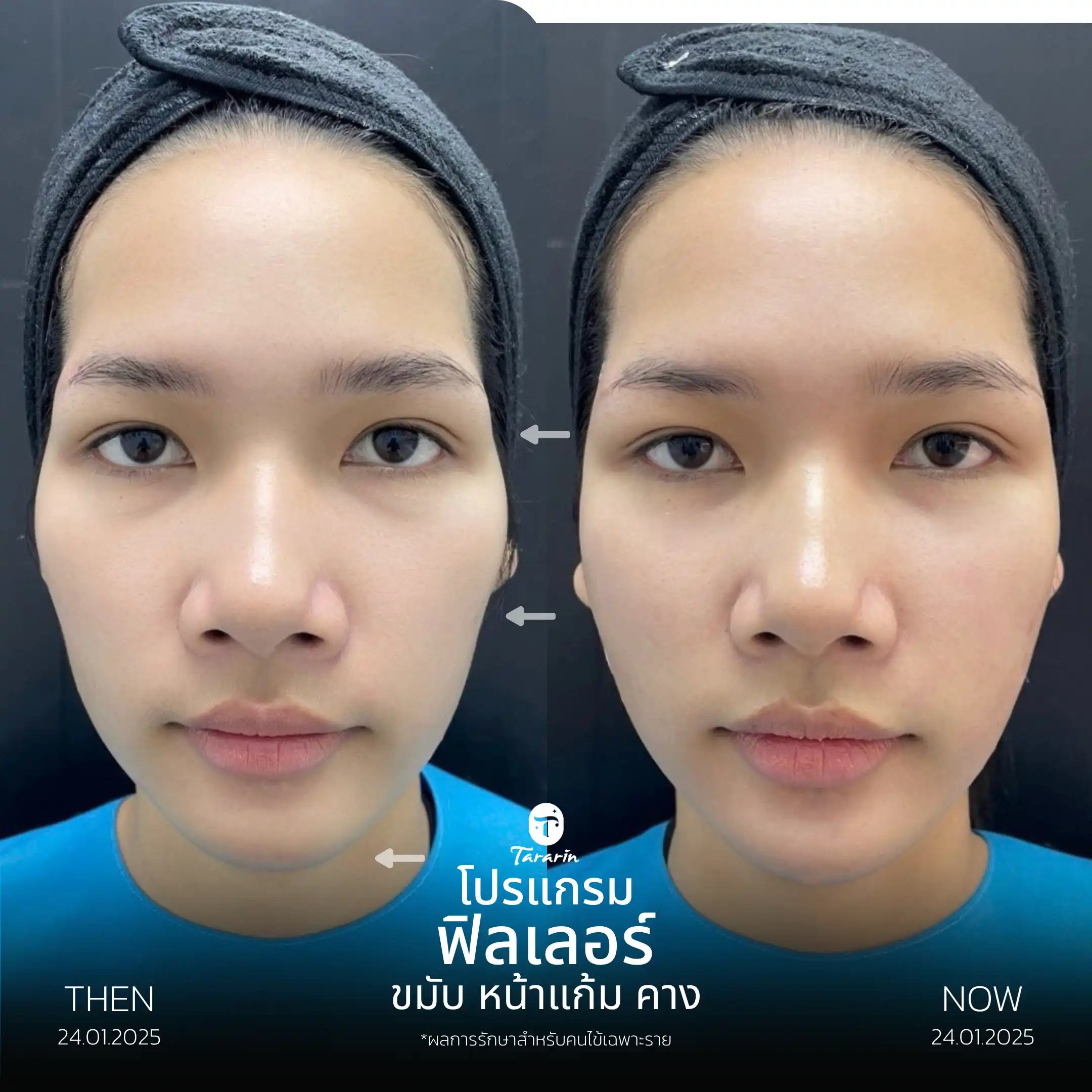 รีวิวฟิลเลอร์แก้มตอบ ขมับ คาง — ธารารินคลินิก
