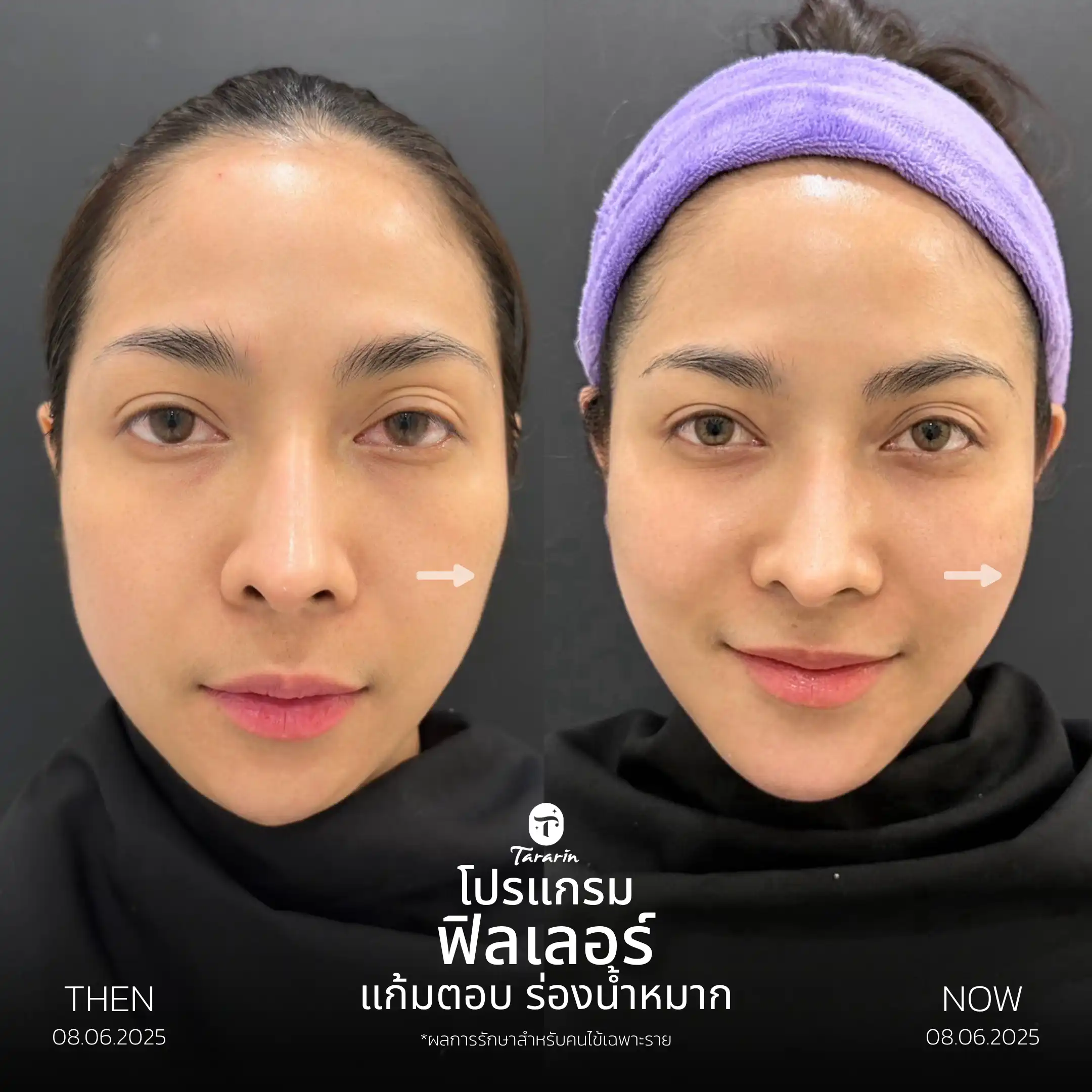 รีวิวฟิลเลอร์แก้มตอบ ร่องน้ำหมาก — ธารารินคลินิก