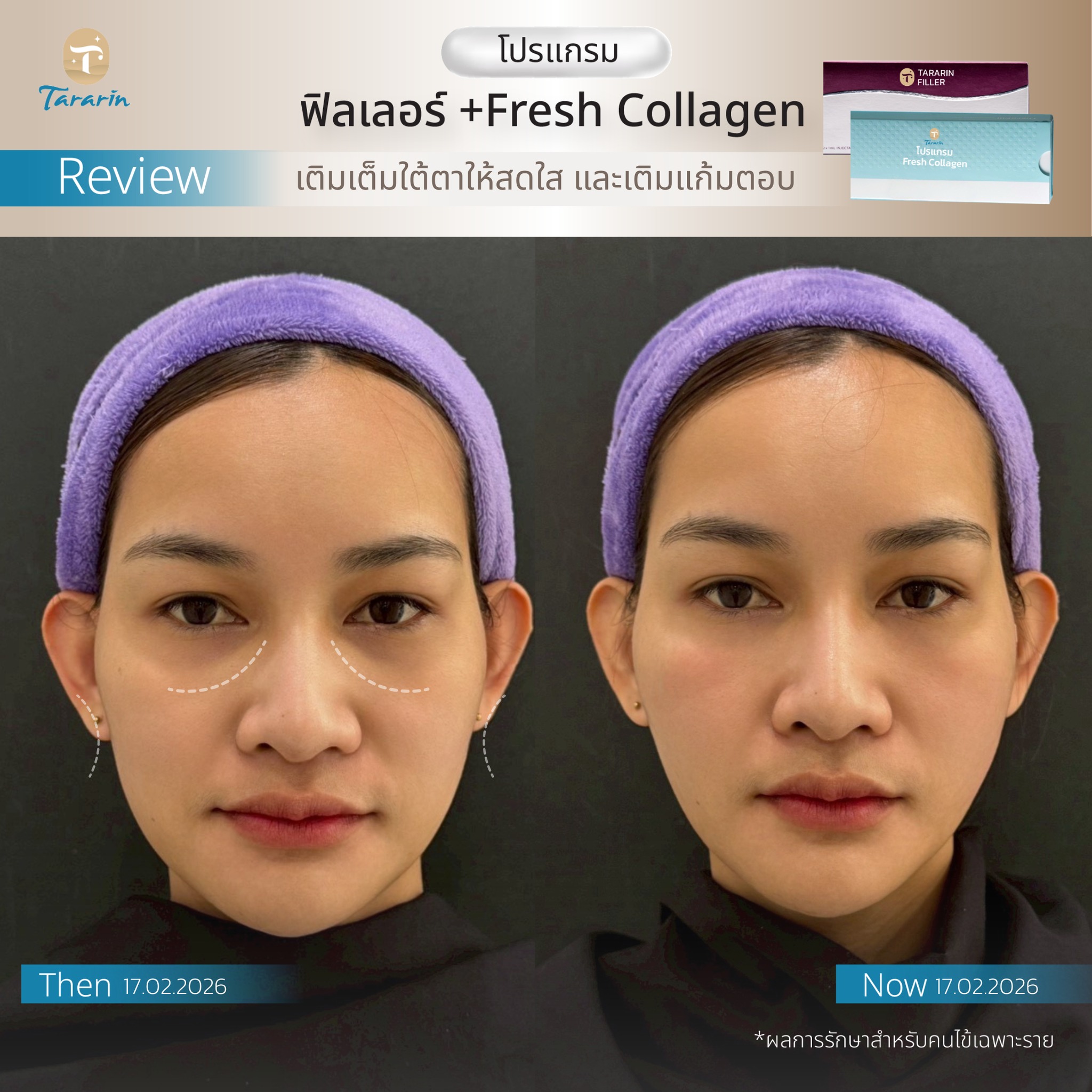 รีวิวโปรแกรมฉีดฟิลเลอร์ใต้ตา พร้อมเติม Fresh Collagen