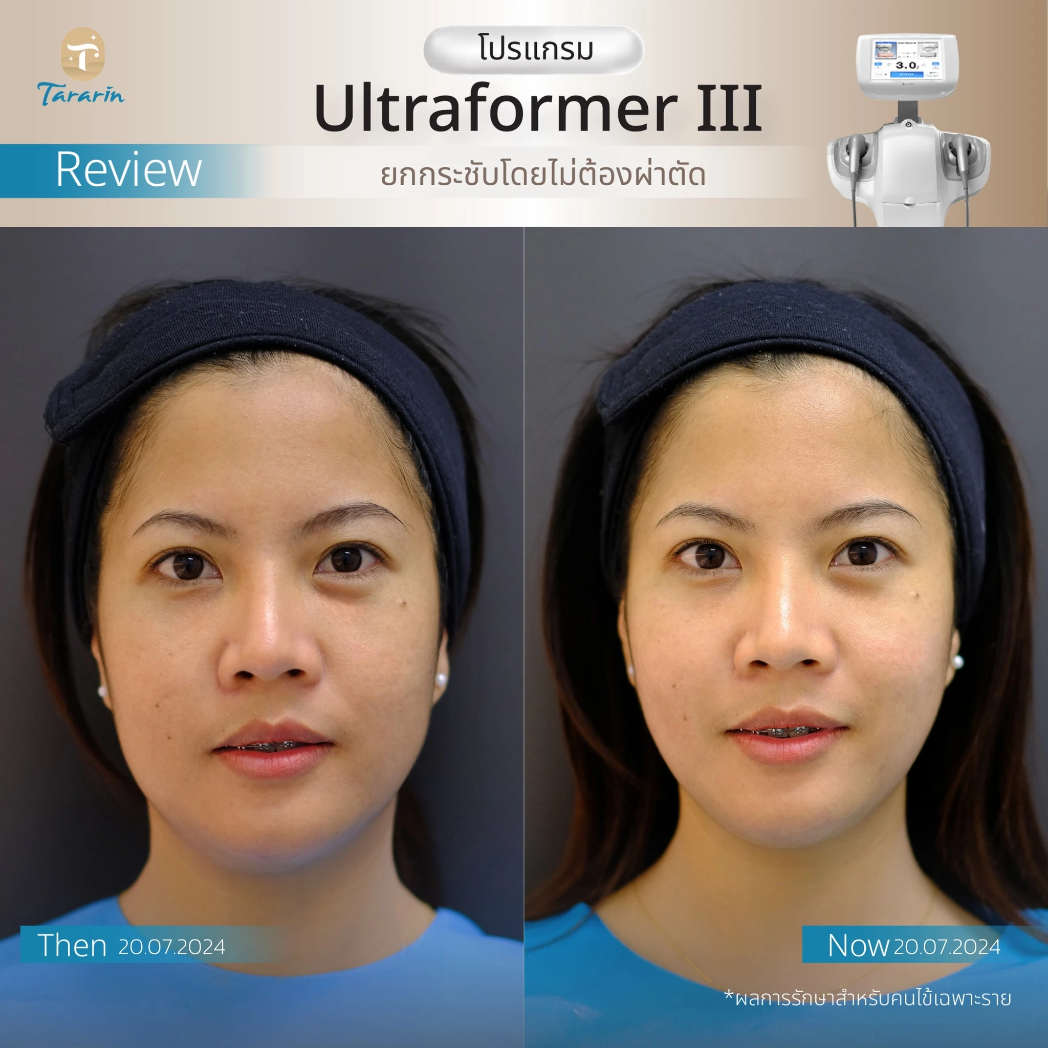 รีวิวโปรแกรม Ultraformer III ยกกระชับกรอบหน้า