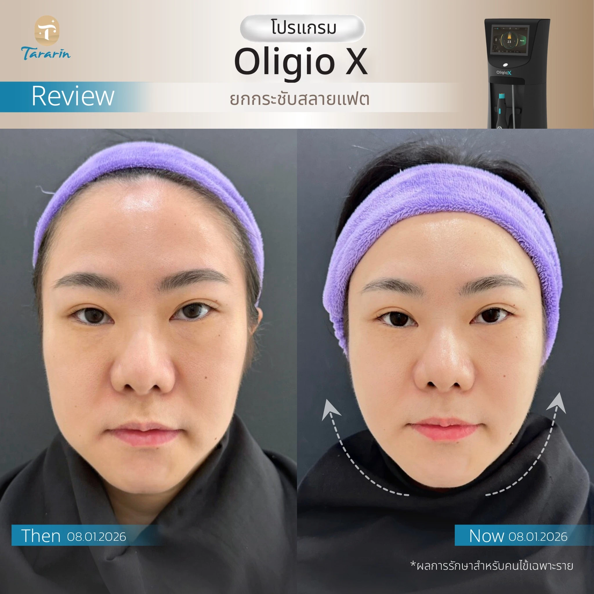 รีวิวยกกระชับใบหน้าด้วยโปรแกรม Oligio X
