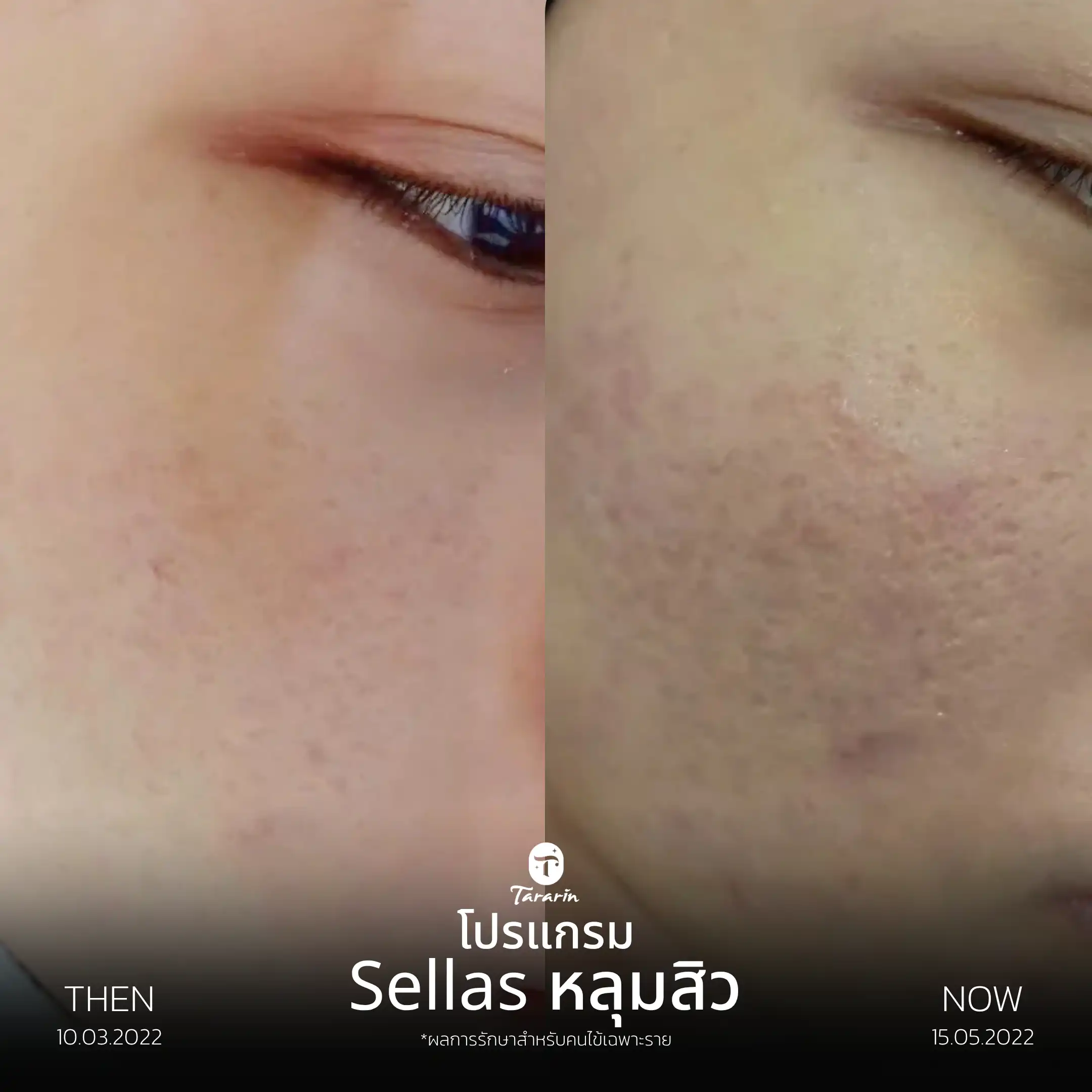 รีวิวโปรแกรม Sallas หลุมสิว — ธารารินคลินิก