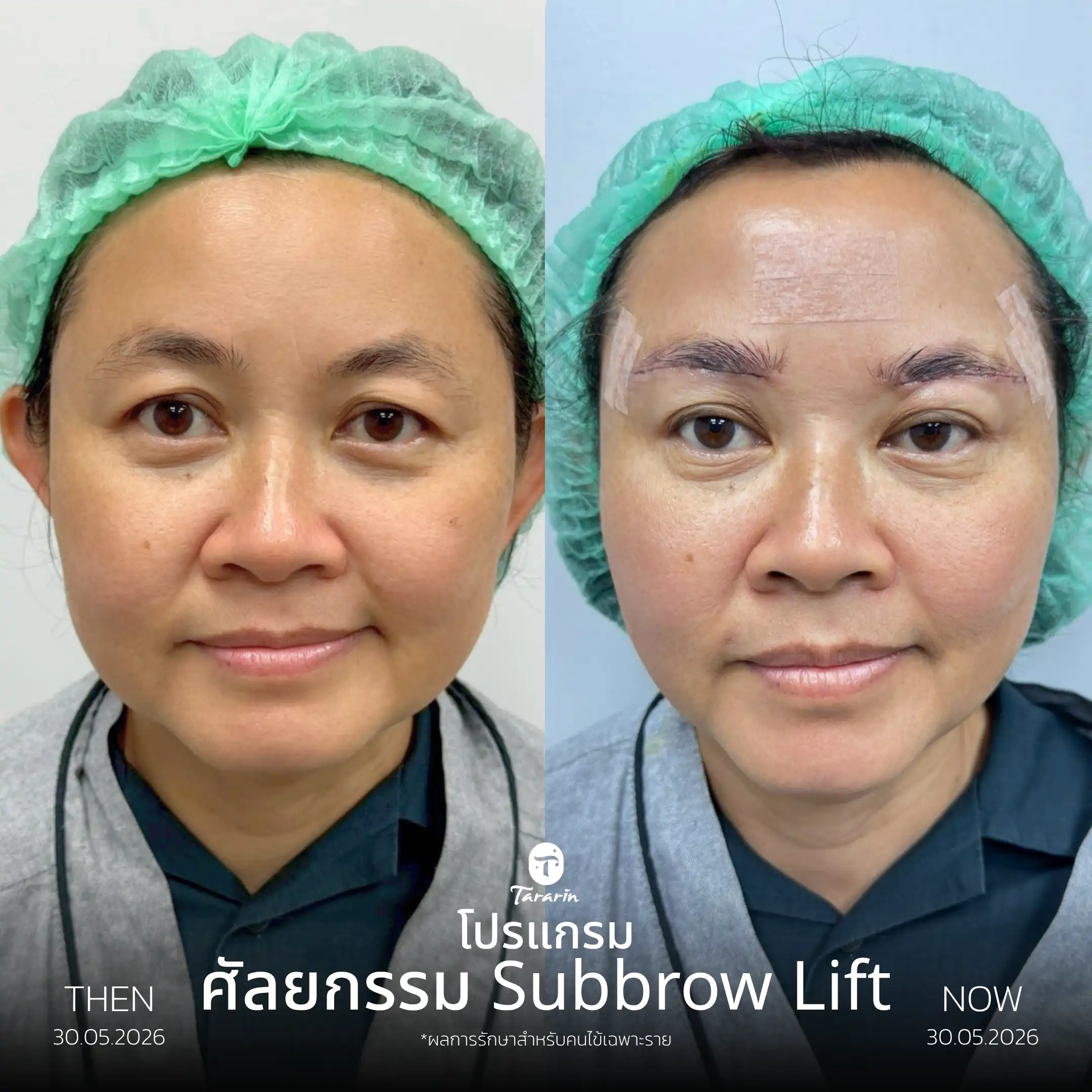 รีวิวศัลยกรรมยกคิ้ว Subbrow Lift — ธารารินคลินิก