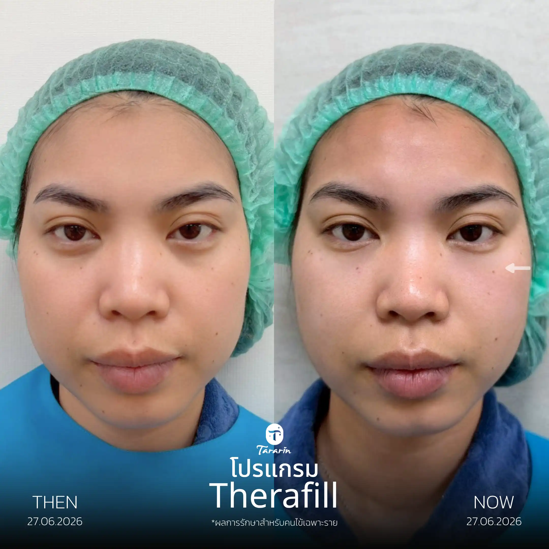 รีวิวโปรแกรม Fresh Collagen ดูแลปัญหาใต้ตา — ธารารินคลินิก