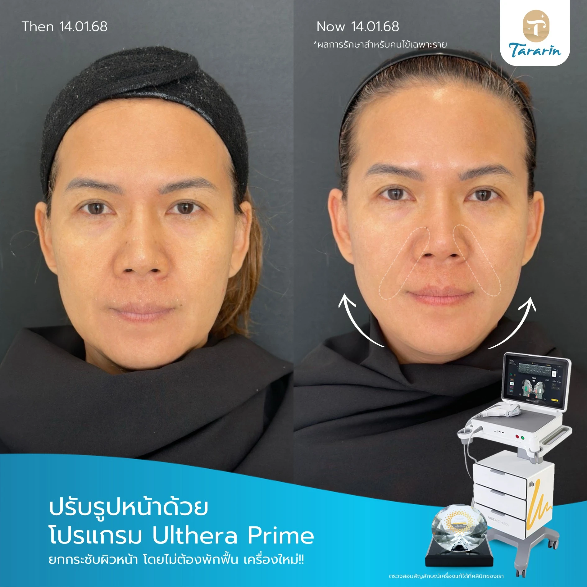 รีวิวปรับรูปหน้าด้วย โปรแกรม Ulthera Prime